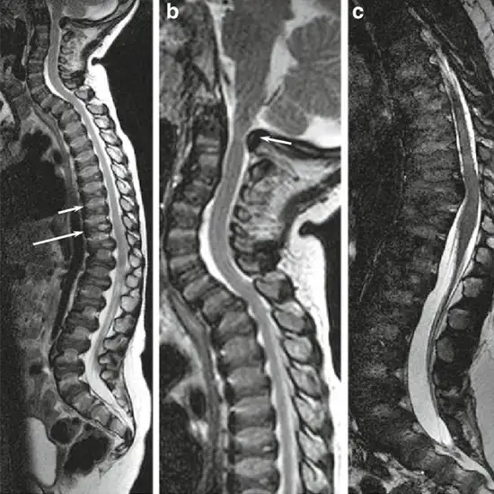MRI Screening Of Cervical Dorsal Spine